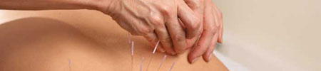 Medisinsk akupunktur